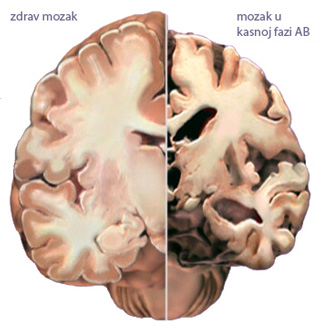Alzheimers-brain.jpg